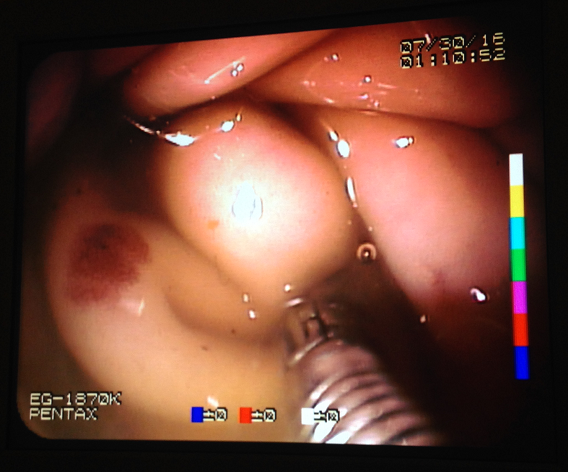 Endoscopy